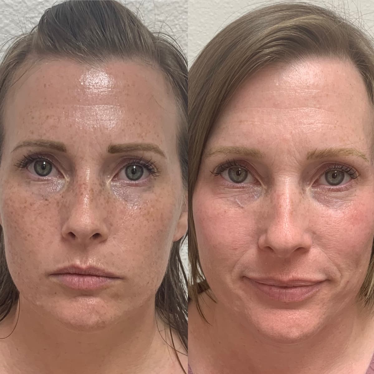 A picture of our patient before microneedling