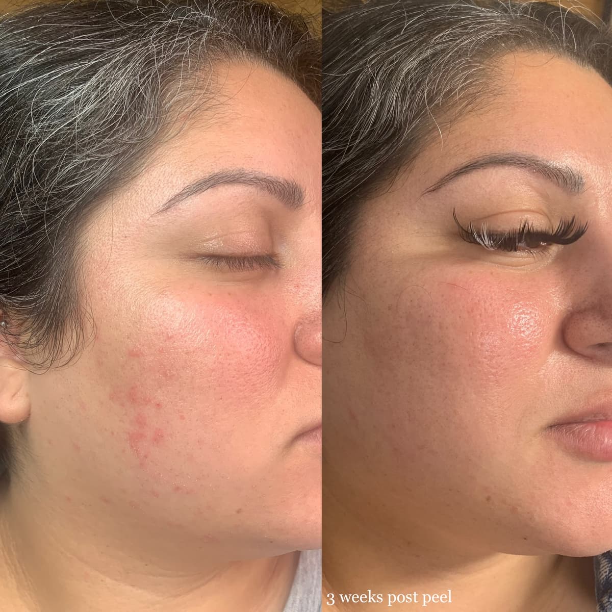 A picture of our patient before microneedling